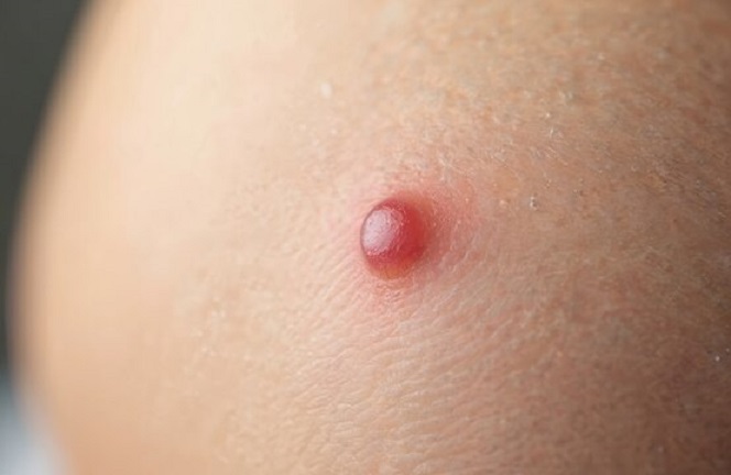 Is Wart Removal minimally invasive