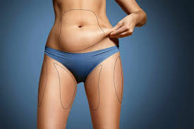 Liposuccion a Paris