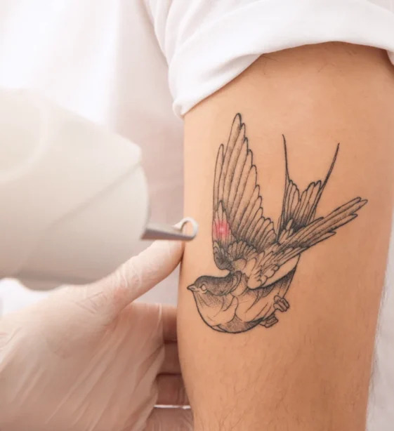 How Can Laser Tattoo Removal Clear Unwanted Ink