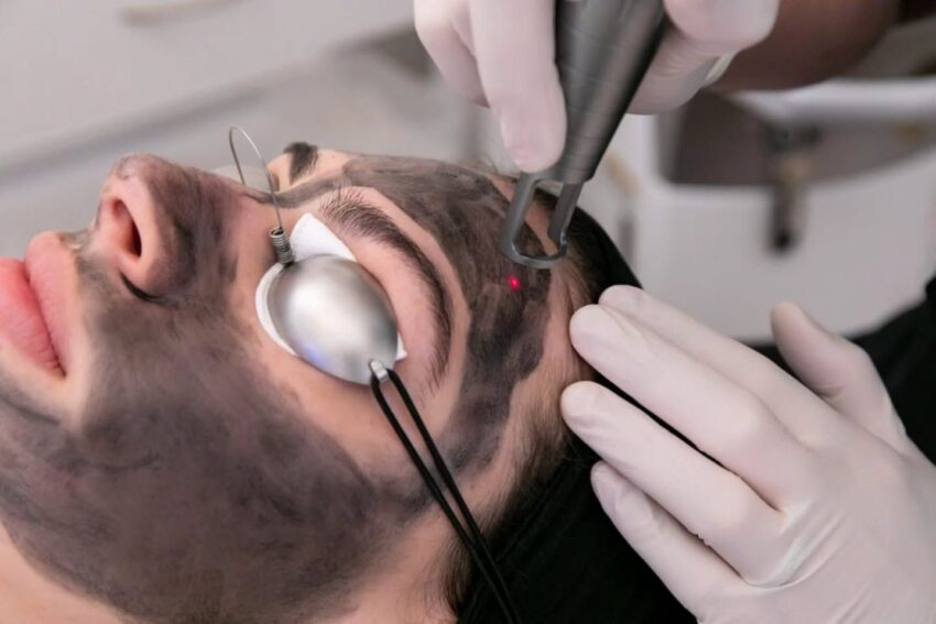 Is Laser Carbon Peels Worth Trying for Clearer Looking Skin