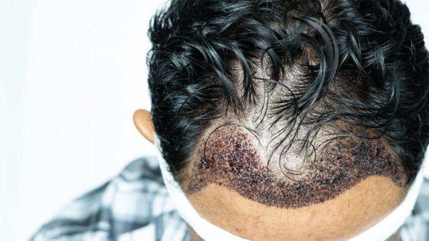 Are hair transplant prices negotiable
