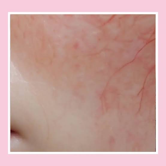 Is Facial Capillaries Treatment suitable for all skin types