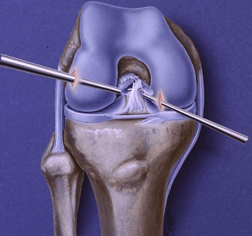 ACL Repair 1024x959 1