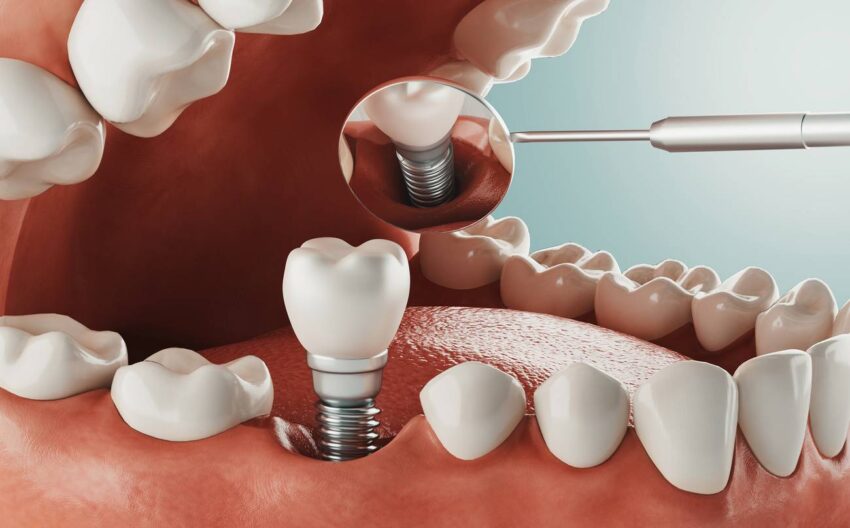 dental implant treatment