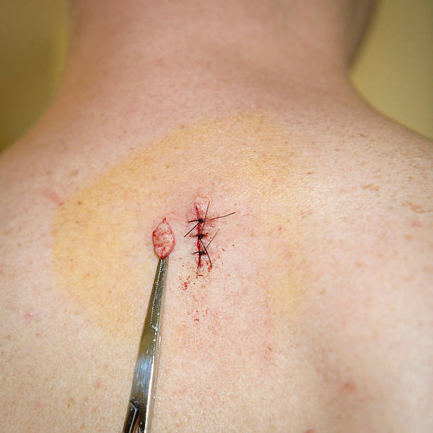 How can Skin lesion removal enhance your natural appearance