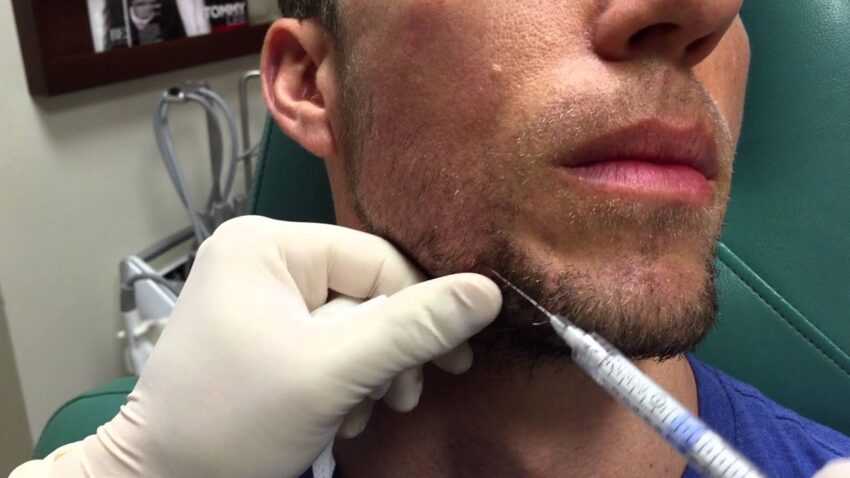 Can Jawline Fillers Injections Change Your Face Shape