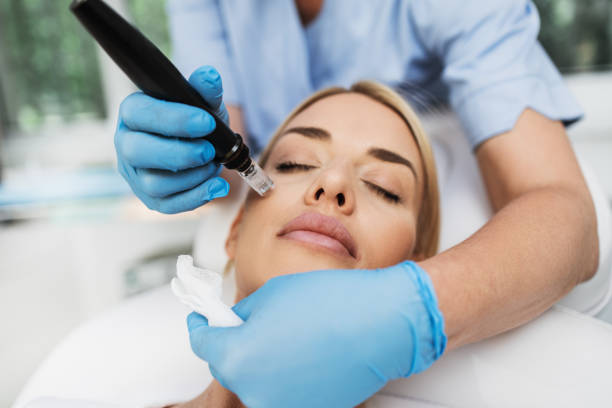 Achieve a Fresh Looking Complexion with Microneedling Treatment