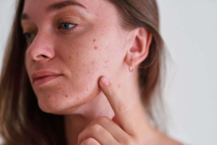 Is Pigmentation treatment effective for post acne dark marks