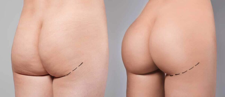 brazilian butt lift Dr Marco Romeo