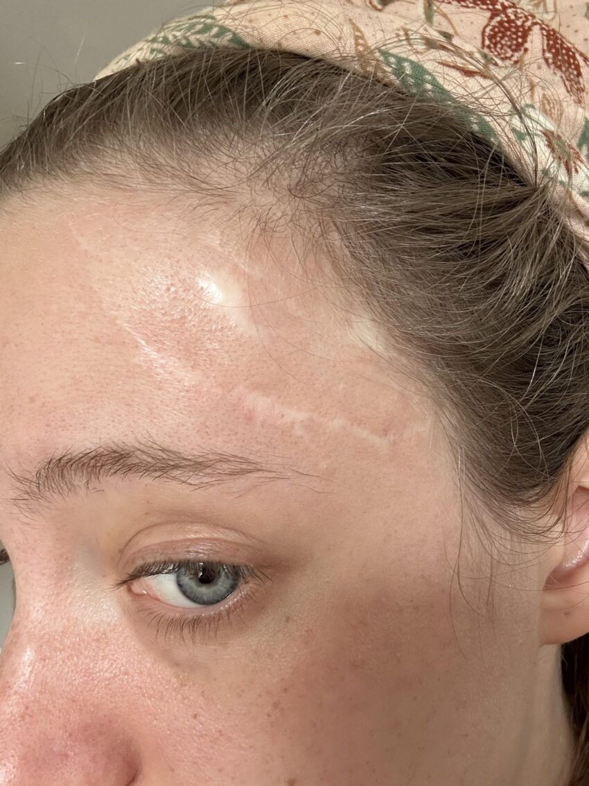 How Does Surgical Scar Revision Improve the Appearance of Scars