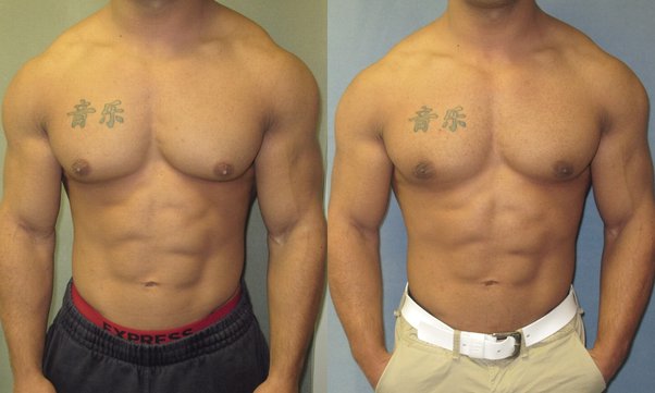 Gynecomastia Surgery UAE Cost