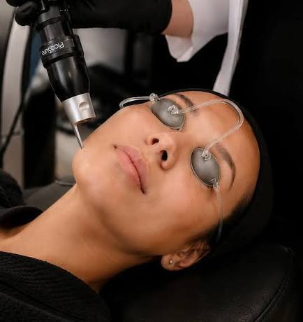 Is Pico Laser Treatment Suitable for Pigmentation