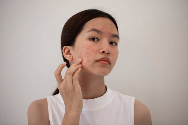 Does Acne treatment work for different skin types