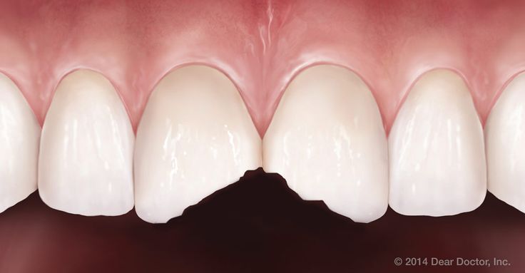 missing damaged teeth hinjewadi