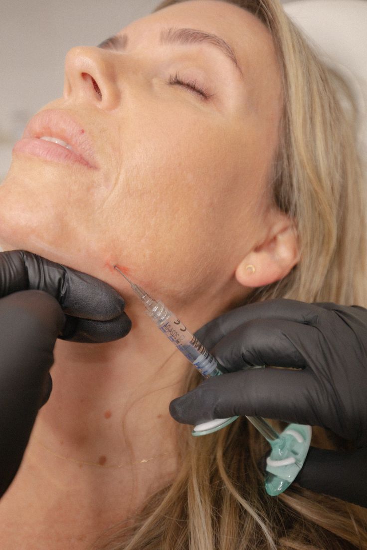 What Results Can You Expect From Jawline Fillers
