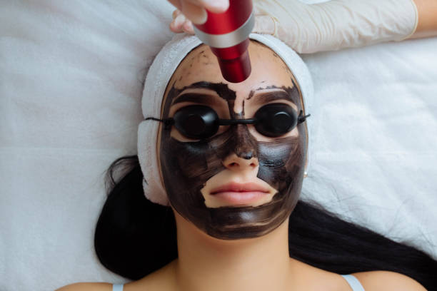 What Makes Laser Carbon Peel So Effective