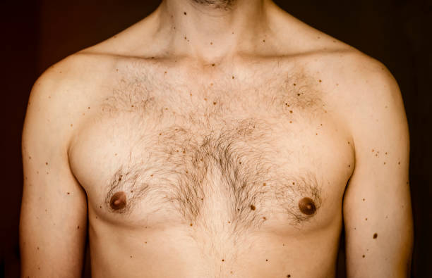 Is Gynecomastia surgery effective for uneven chest appearance