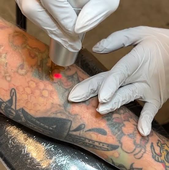 Does Laser tattoo removal work better on certain skin tones