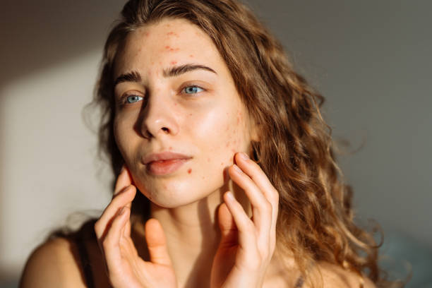 Is Acne treatment Suitable for Oily Skin Types
