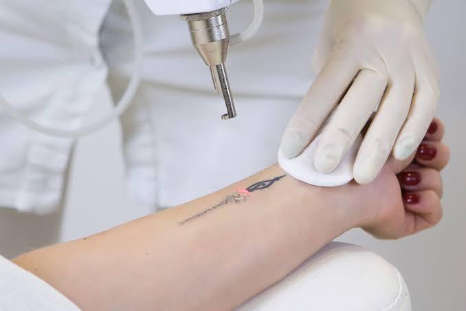 What Should You Expect From Laser Tattoo Removal