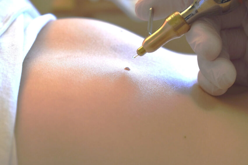 How Does Skin Lesion Removal Improve Skin Texture