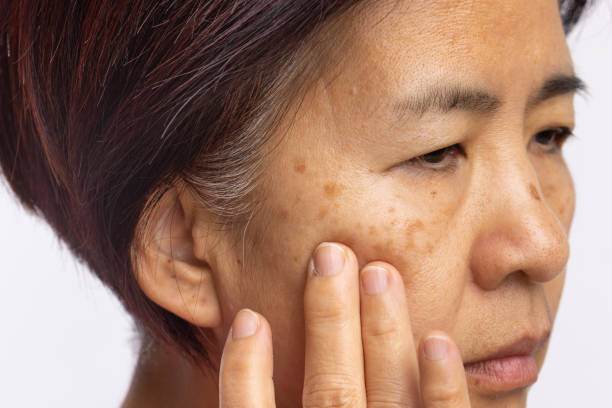 Is Melasma Treatment Good for Stubborn Melasma