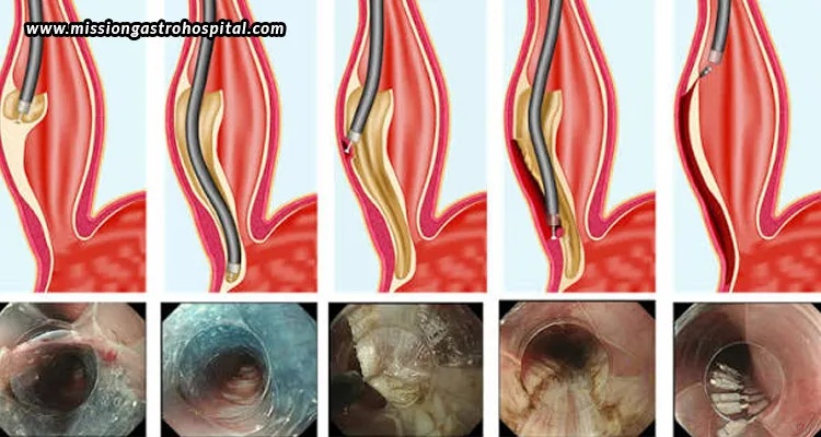 Mission Gastro Hospital Specialized Gastroenterology Care For POEM