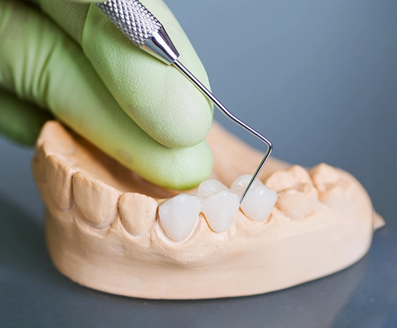 Full Mouth Implants Costa Mesa for Complete Smile Restoration