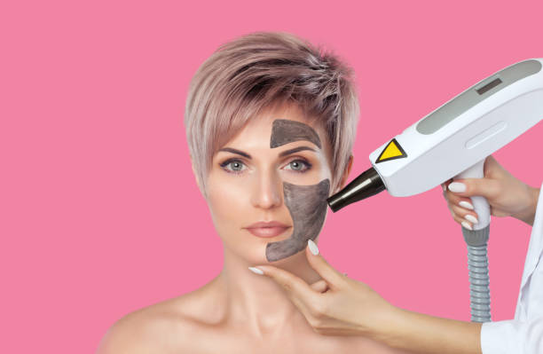 Does Laser carbon peel help create a fresher appearance