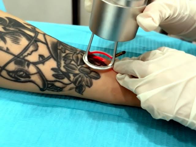 How can Laser tattoo removal support clearer looking skin
