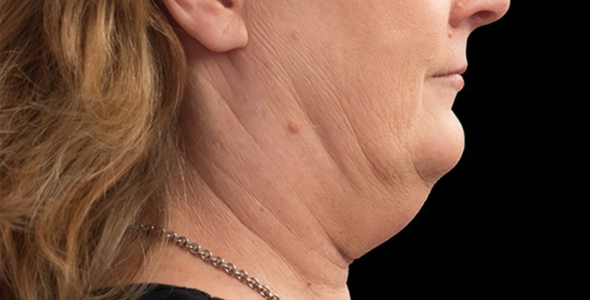 Can Double Chin Liposuction Define a Less Prominent Jawline