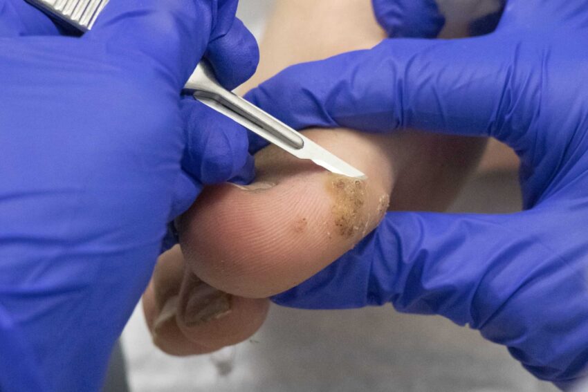 What Questions Should You Ask a Wart Removal Clinic