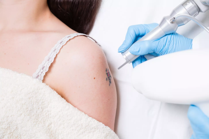 How Does Aging Skin Affect Laser Tattoo Removal