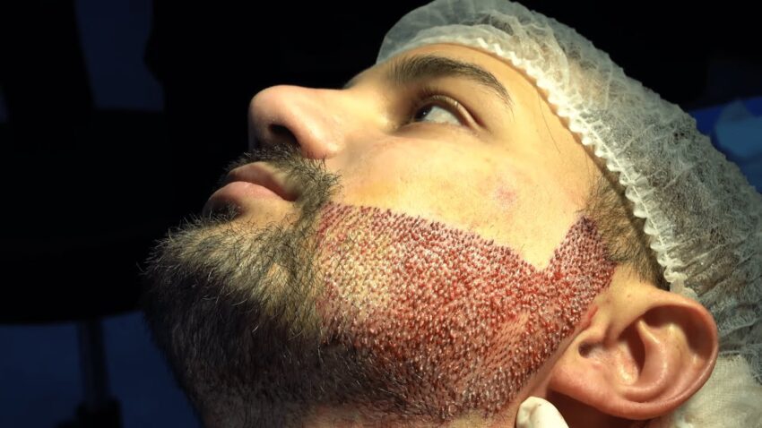 What Factors Affect the Appearance of Beard Hair Transplant Results