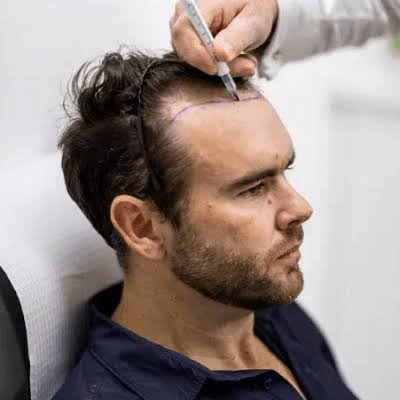 What factors affect FUE hair transplant treatment
