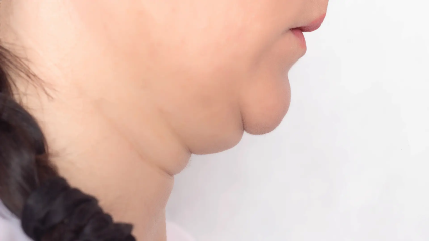 Could Surgical Double Chin Removal Improve Neck Contours