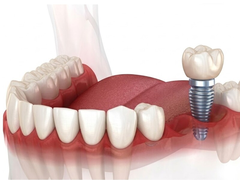 Implant