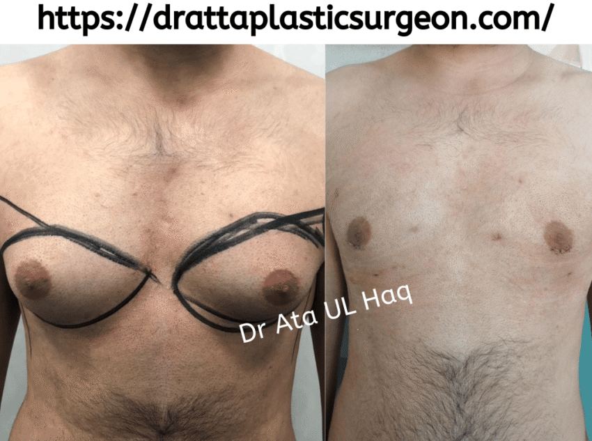 Gynecomastia surgeon in Lahore
