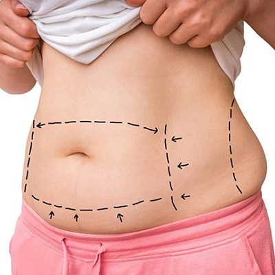 Liposuction Clinic in Muscat