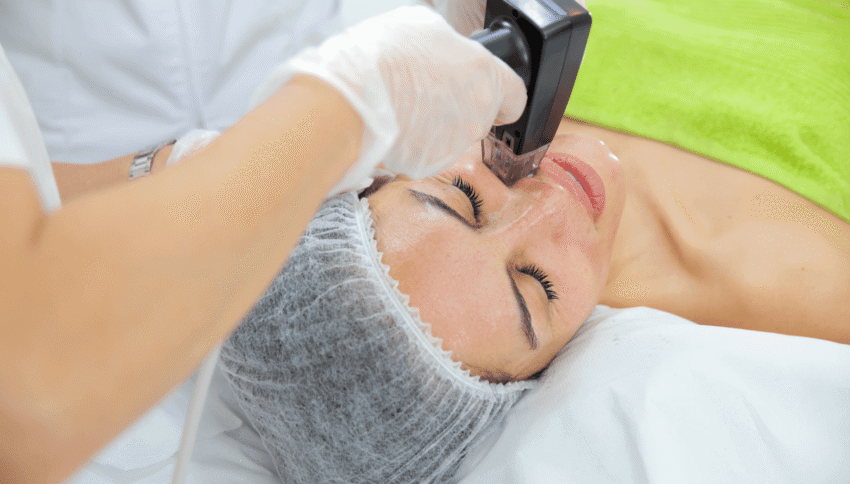 Could Morpheus8 Treatment Improve Acne Scars and Pores
