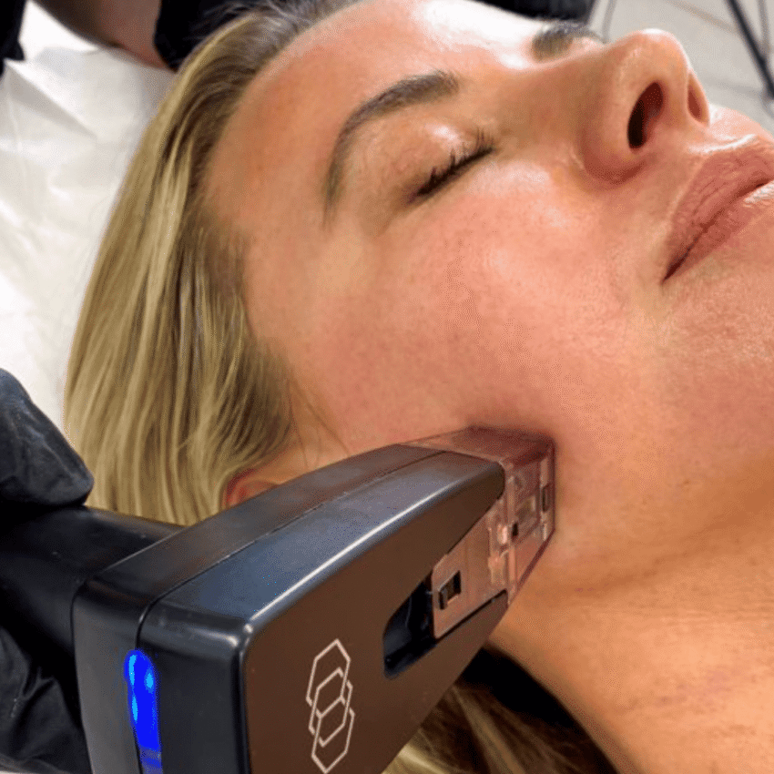 Could Morpheus8 Skin Treatment Help Improve Neck Skin