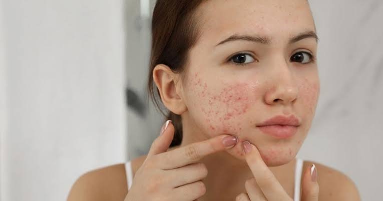 Acne Treatment in Dubai22 1