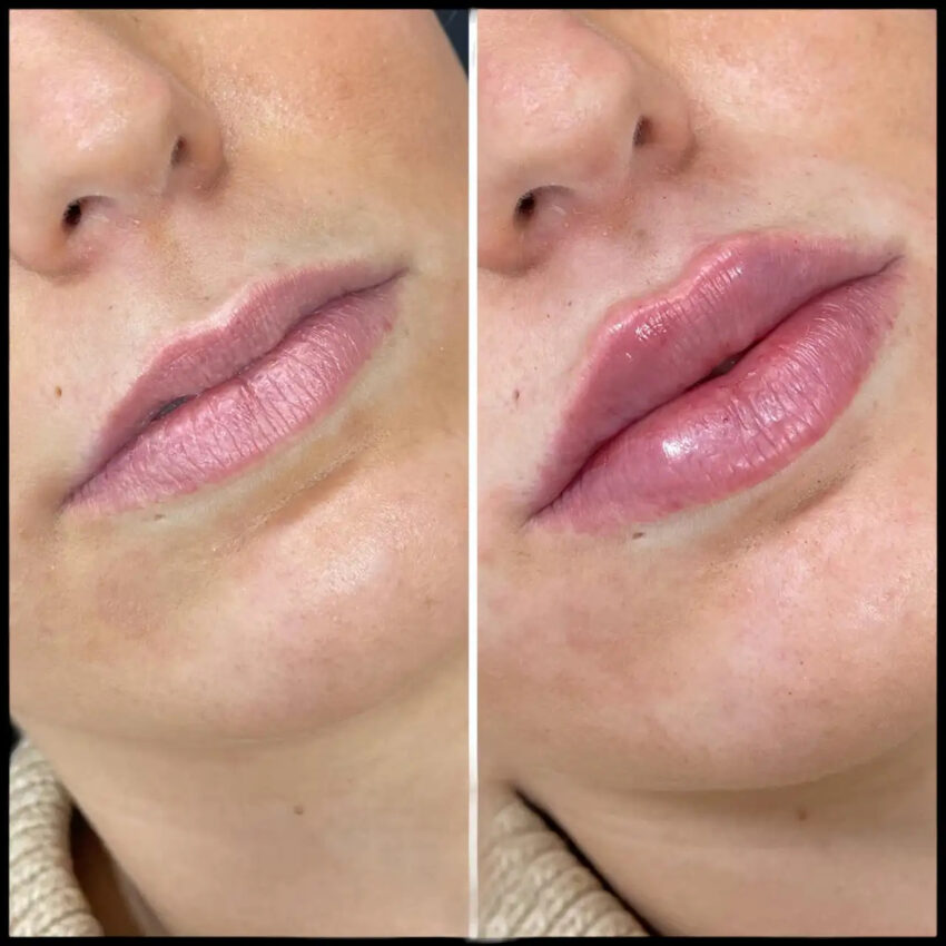H7 lip fillers IMAGE