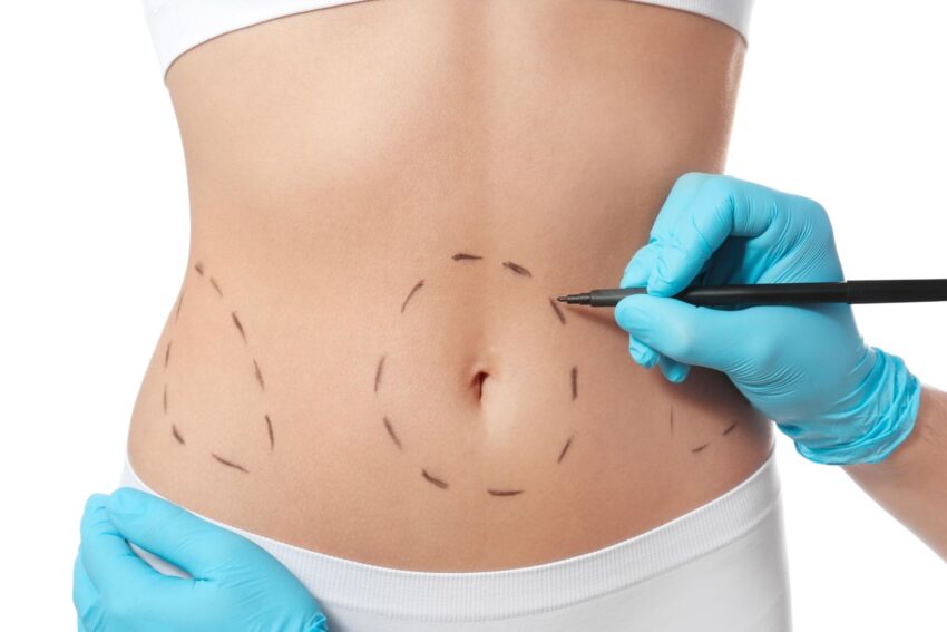 What Questions Should You Ask About Liposuction Cost