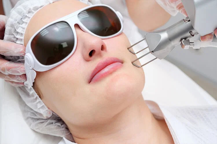 Fractional CO2 Laser Treatment In Riyadh