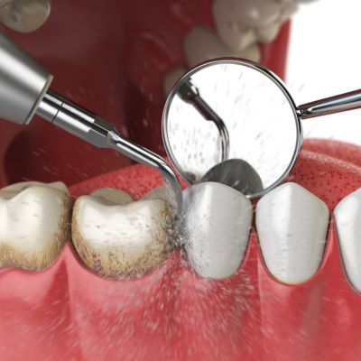 teeth cleaning