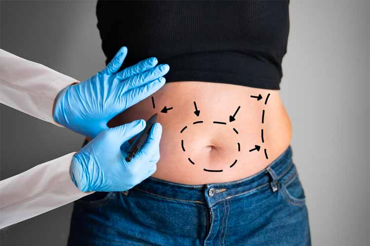 liposuction 1
