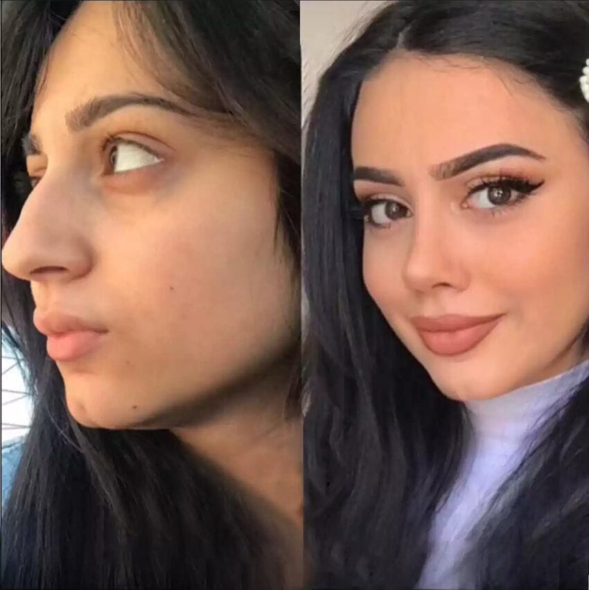 rhinoplasty