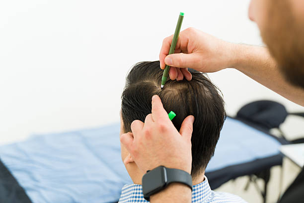 What happens during a Hair Transplant consultation