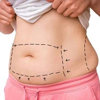 Liposuction in Islamabad27